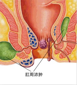 专家诊断:通过检查确诊为肛周脓肿.